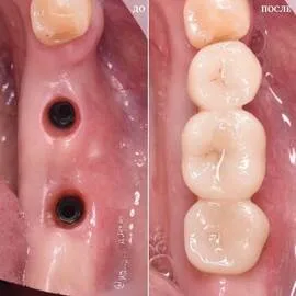 Импланты Dentium