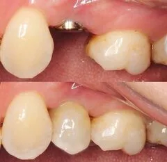 импланты Дентиум src=