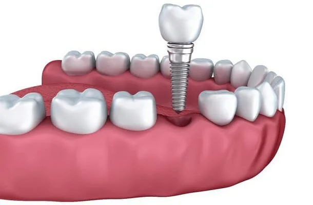 Бюгельный протез