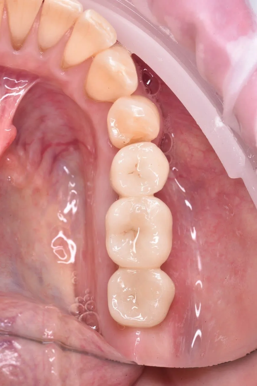 Бюгельные протезы