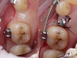 Имплантация 1 зуба под ключ