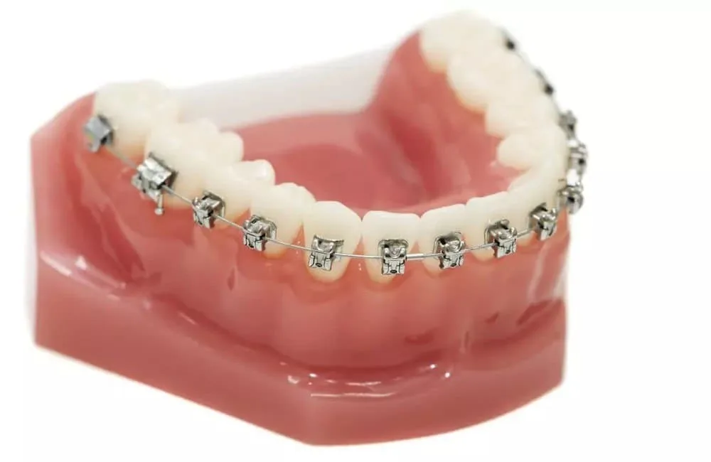 Установка брекетов на нижнюю челюсть