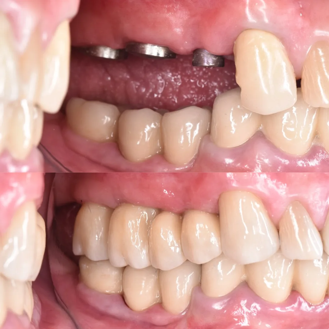 Импланты Штрауман