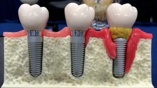 удаление импланта зуба