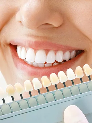 Рекомендации после установки виниров