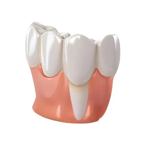 Рецессия десны - обнажение корня зуба: причины и методы лечения