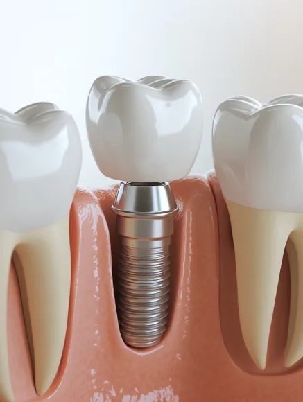 Двухэтапная имплантация зубов