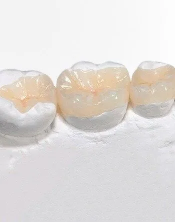 Стоматологические вкладки