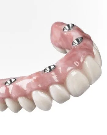 Условно-съемное протезирование