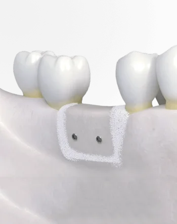 Синус-лифтинг и костная пластика