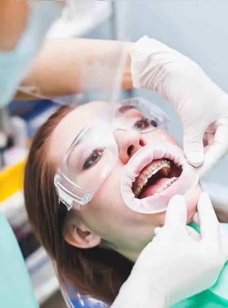 Металлические брекеты