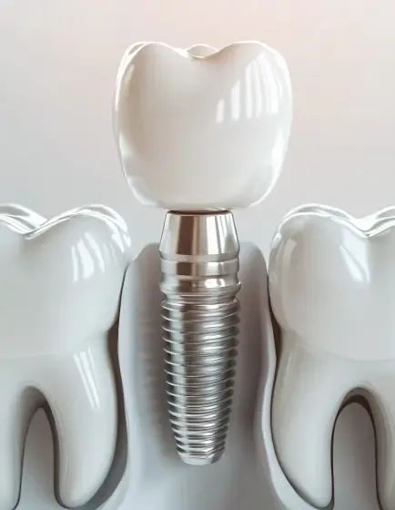 Имплантация одного зуба