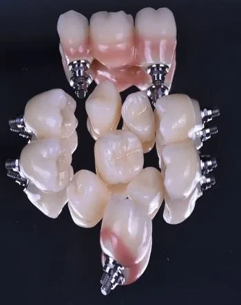 Коронка на имплант