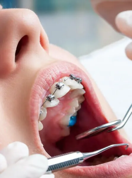 Исправление прикуса