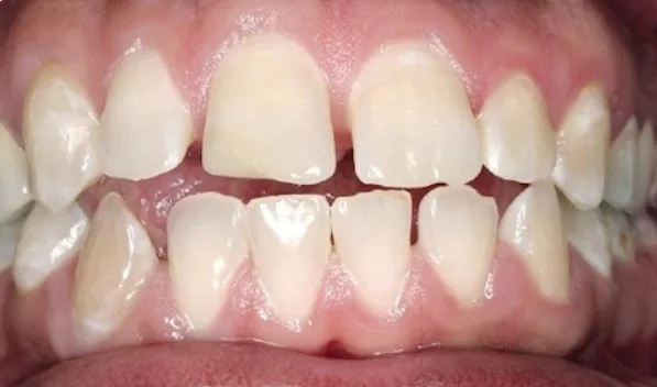 Исправление открытого прикуса До