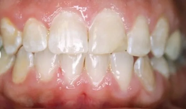 Исправление открытого прикуса После