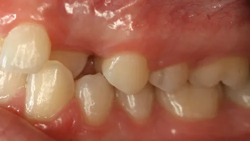 Исправление перекрестного прикуса До