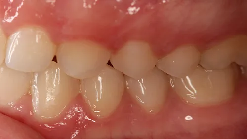 Исправление перекрестного прикуса После