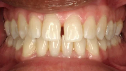 Скрытие межзубных промежутков До