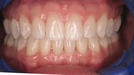 Скрытие межзубных промежутков После