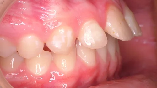 Коррекция глубокого прикуса с сагиттальной щелью до