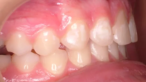 Коррекция глубокого прикуса с сагиттальной щелью после