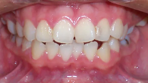 Исправление скученности зубов До