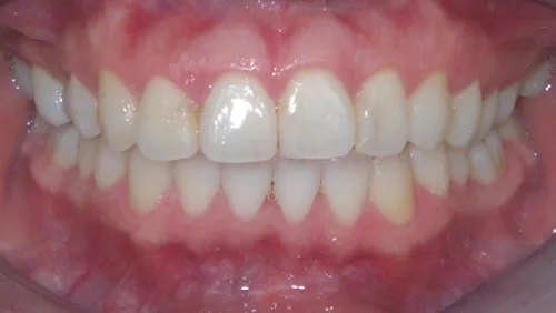 Исправление скученности зубов После