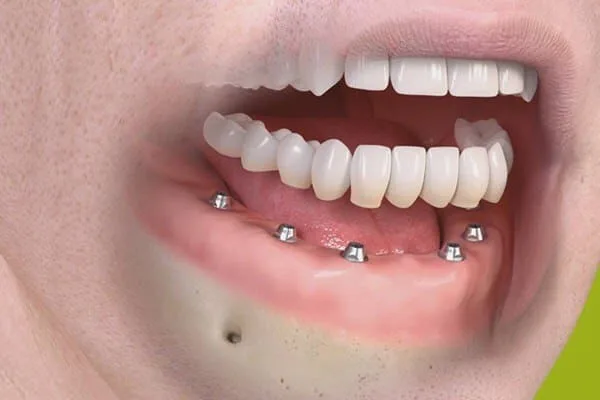 Импланты all on 6