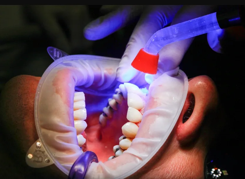 исправление формы зуба