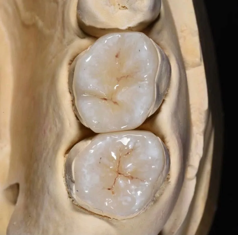 реставрация зубными коронками