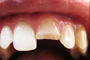 Сколы эмали после травмы