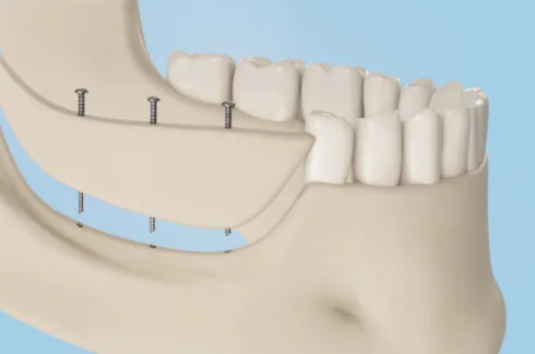 наращивание кости