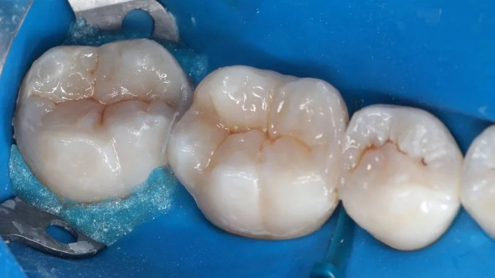 Реставрация жевательных зубов