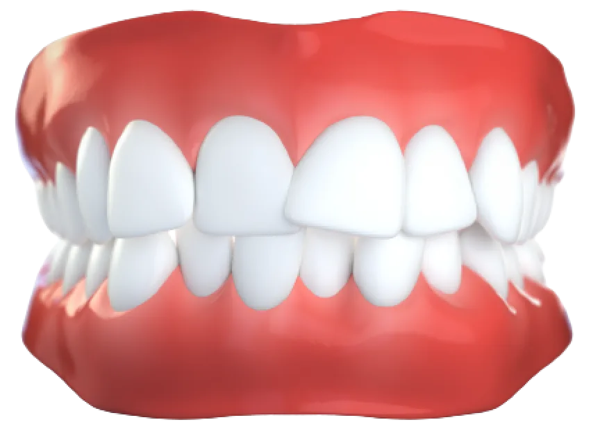 Скученность зубов