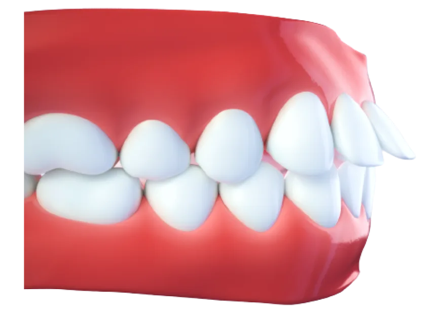 Саггитальная щель