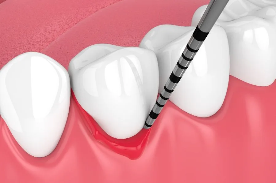 лечение воспаления парадонта
