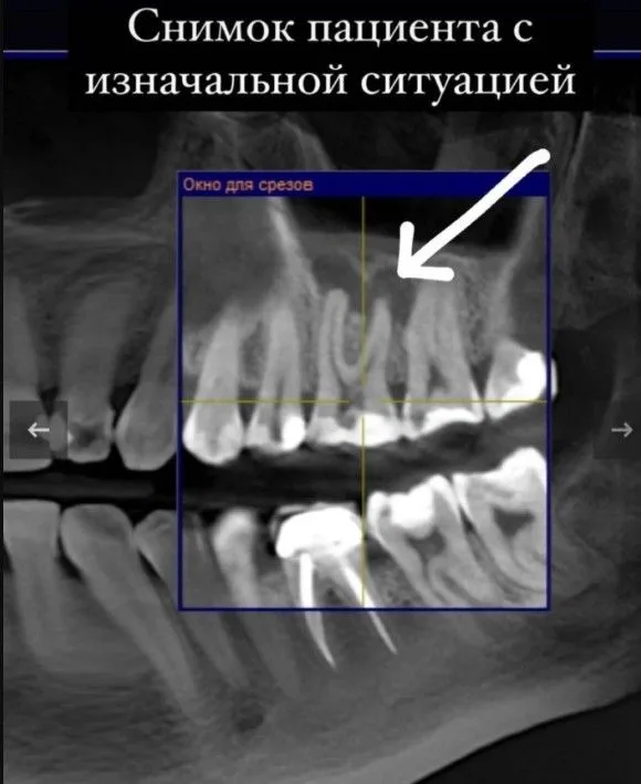 хронический апикальный периодонтит