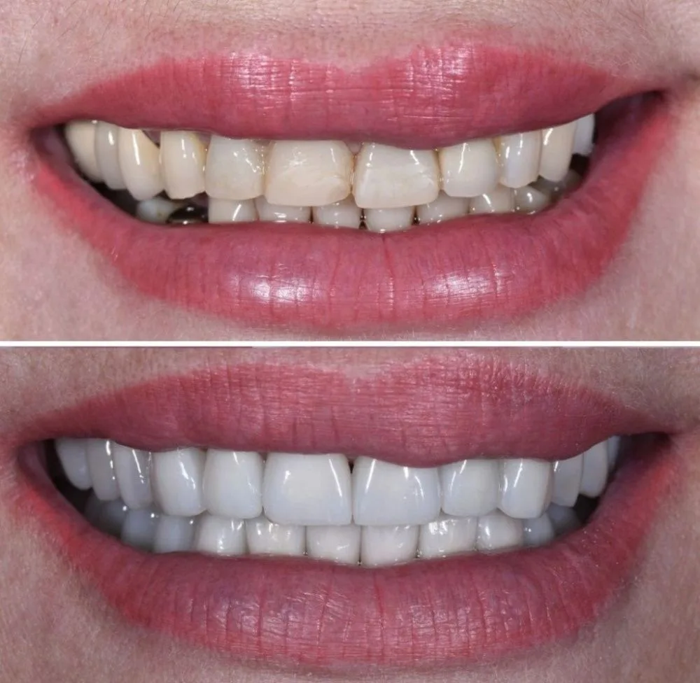 реставрация зубов