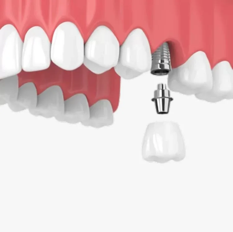 имплантация верхней челюсти показания