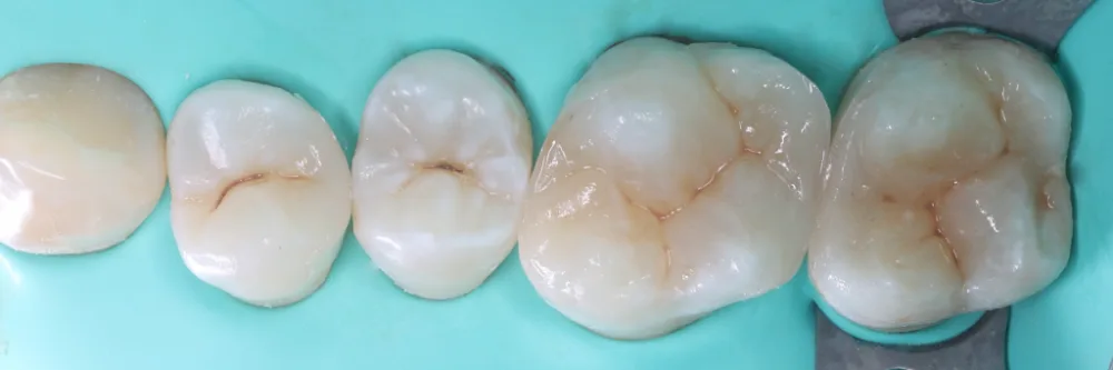 временные пломбы