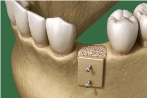 наращивание кости челюсти