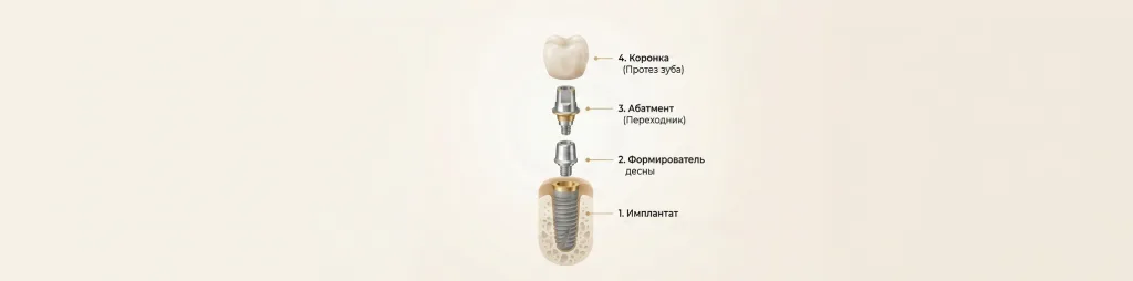 3 Из чего складывается стоимость имплантации.png
