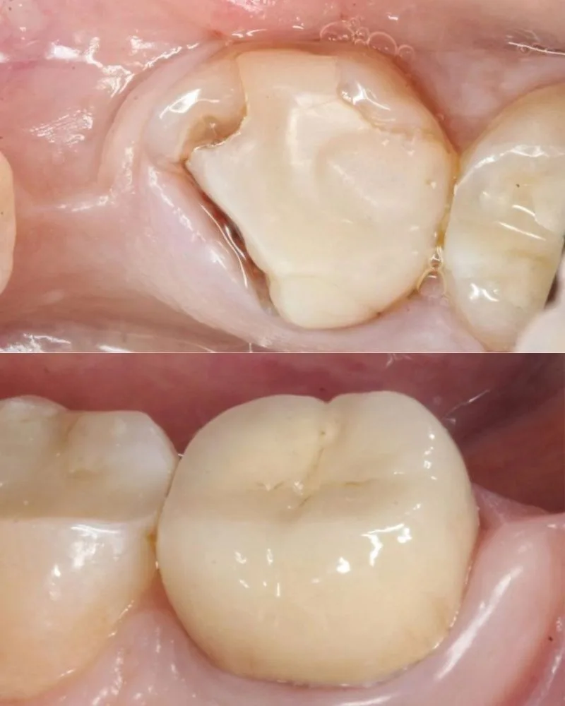 Реставрация зубов