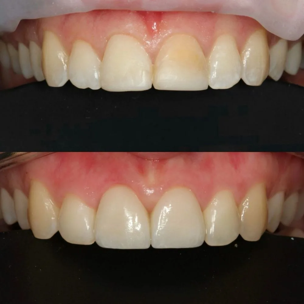 реставрация зубов