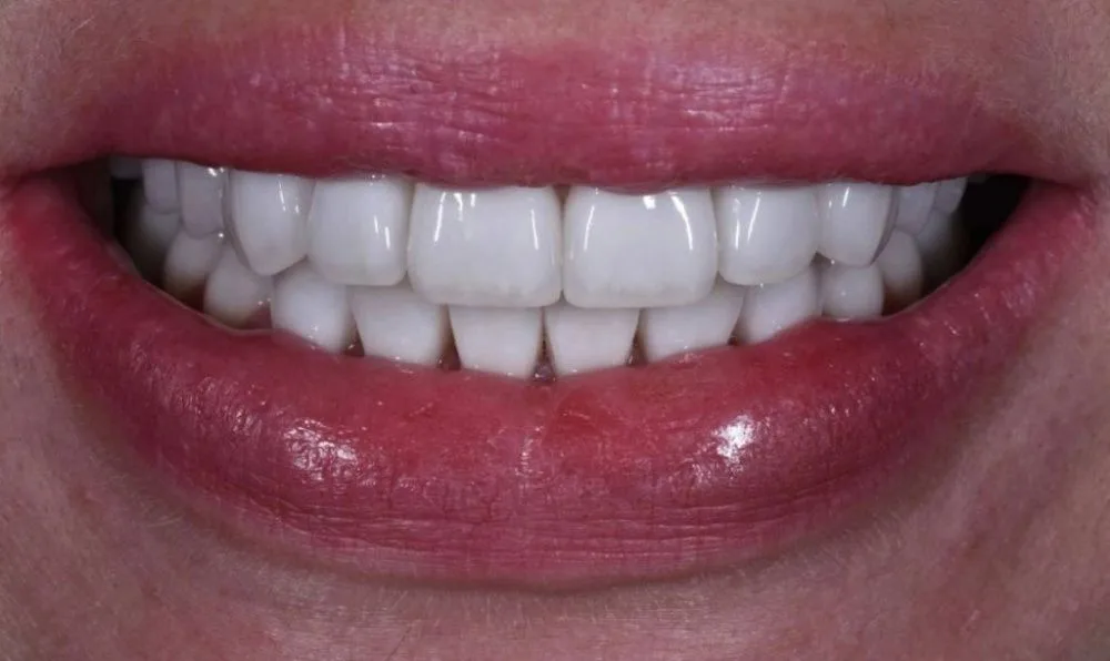 Реставрация передних зубов