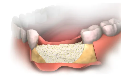наращивание кости перед имплантацией