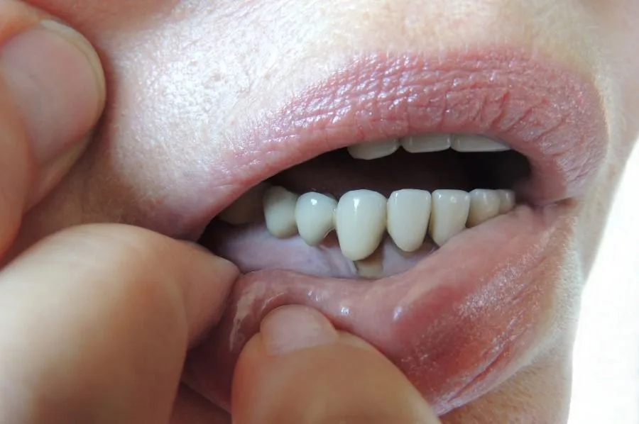 лечение парадонтита