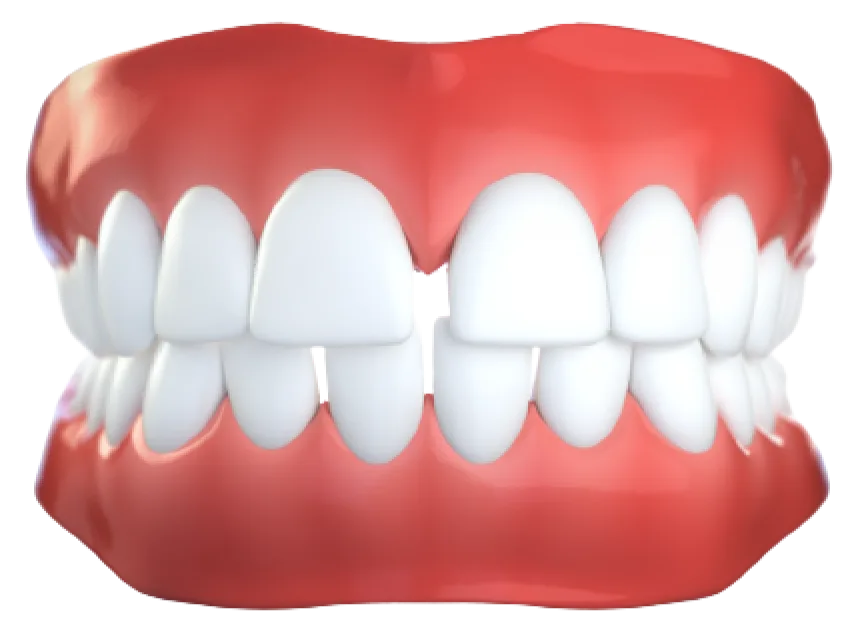 Зубы с большим промежутком, диастемами