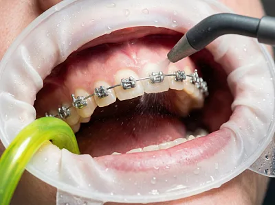 Профессиональная чистка зубов — со скидкой 15%. 